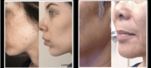 efficacy of Lumecca skin treatment