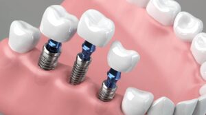 Aftercare for Dental Implantation